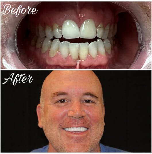 ProSmiles OC | Ceramic Crowns, Oral Cancer Screening and Root Canals