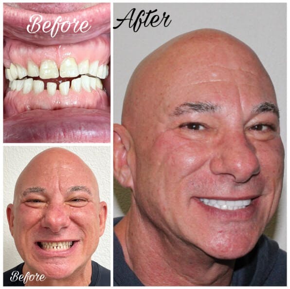 ProSmiles OC | Sports Mouthguards, Invisalign reg and Ceramic Crowns