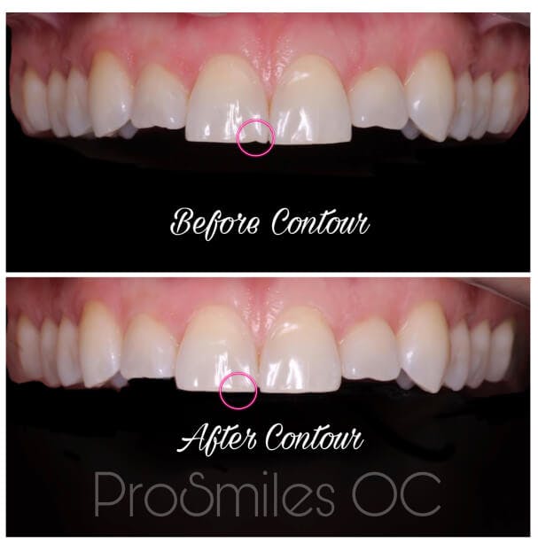 ProSmiles OC | Extractions, Full Mouth Reconstruction and Invisalign reg