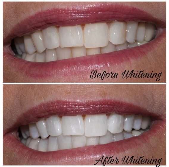 ProSmiles OC | All-on-6 reg , Digital Impressions and Dental Sealants