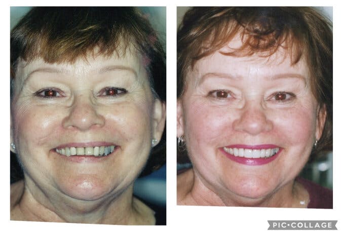 ProSmiles OC | Inlays amp Onlays, Botox reg and Cosmetic Dentistry