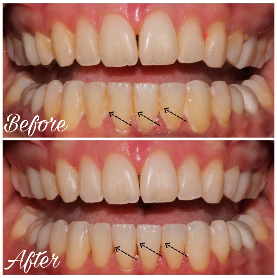 ProSmiles OC | Sedation Dentistry, Dental Bridges and Air Abrasion