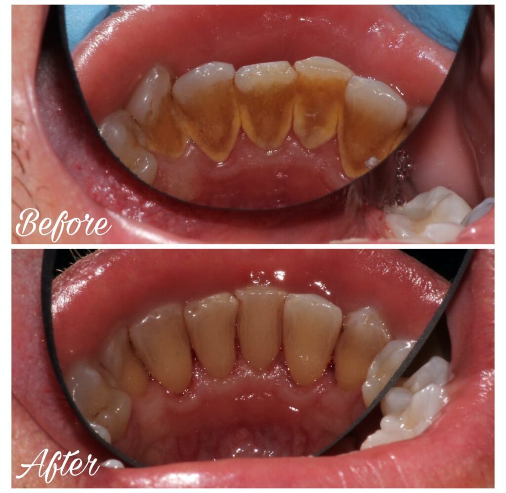 ProSmiles OC | Dentures, Digital Impressions and Oral Exams