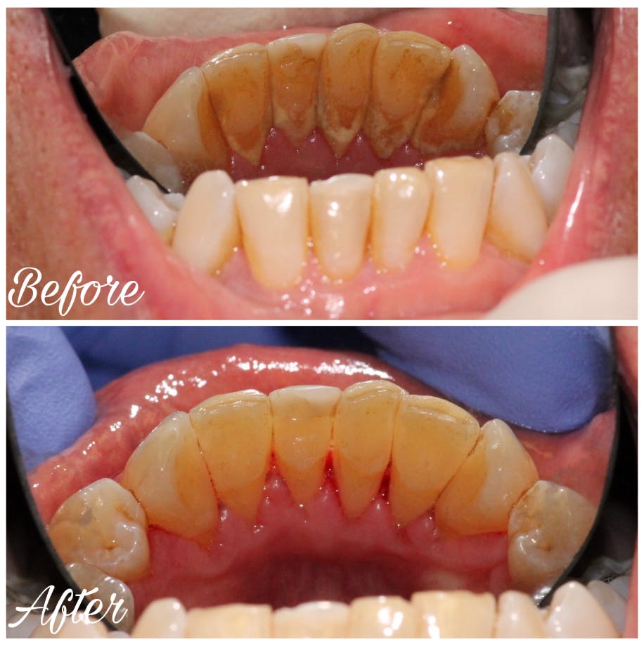 ProSmiles OC | Oral Cancer Screening, Intraoral Camera and Implant Dentistry