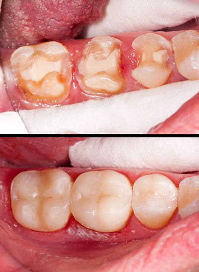 ProSmiles OC | All-on-6 reg , Digital Radiography and Veneers