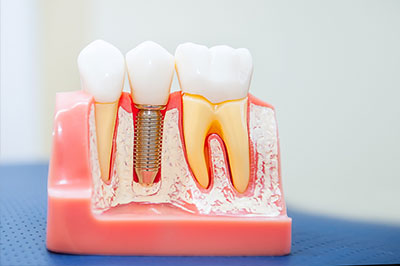 ProSmiles OC | Invisalign reg , Periodontal Treatment and Dental Sealants