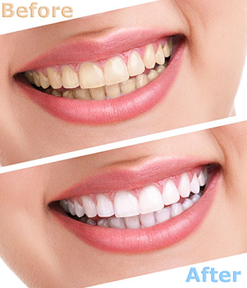 ProSmiles OC | Veneers, Preventative Program and Implant Restorations