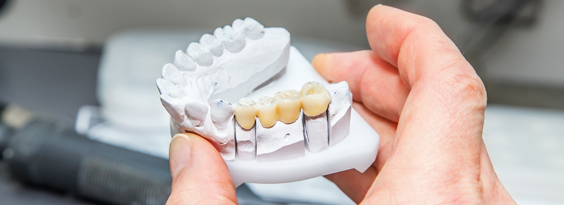 ProSmiles OC | CEREC, Ceramic Crowns and All-on-6 reg